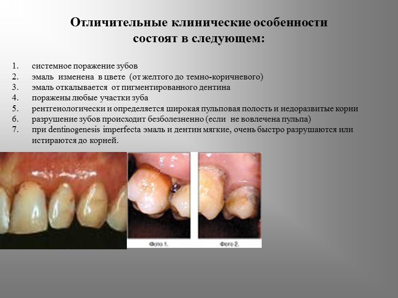 Отличительные клинические особенности состоят в следующем: системное поражение зубов эмаль  изменена  в